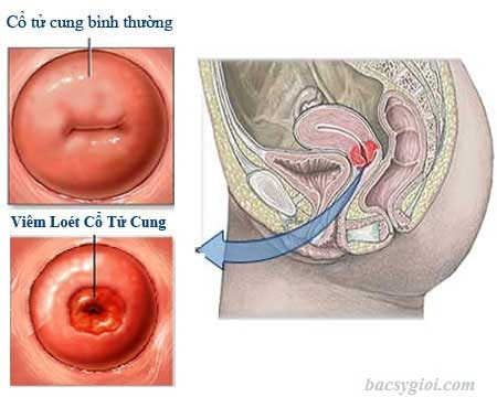 Viêm cổ tử cung có nguy cơ gây vô sinh không