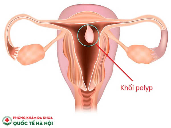 hình ảnh polyp cổ tử cung