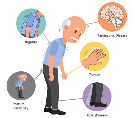 Bệnh Parkinson là gì